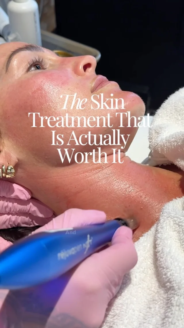 THE skin treatment that is actually worth it!💁🏻‍♀️ Consistent microneedling has changed the texture of my skin! The pen has tiny little needling that puncture the skin and stimulate collagen production - YES please! I’ve been doing it 2-3x/year for the past 4 years. Now that I’m 40 I’m so happy I added this into my skin routine! LOVE the glow I get about a week after doing it (in the video)✨✨

If you want to learn more I have a detailed blog post on SBKliving.com - comment “SKIN” and I’ll send it to your DMs🙆🏻‍♀️

Thanks to @simplyskinmedispa for always doing this treatment for moi✨😘

#microneedlingtherapy #microneedlingbeforeandafter #skincaretreatment